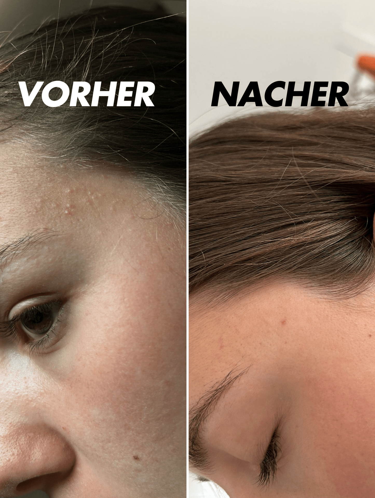 Akne Pflege Creme - SkinElixir